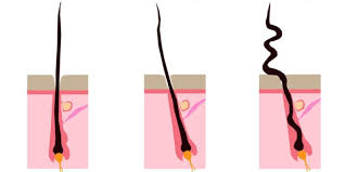 Diagnosis of hair shaft condition